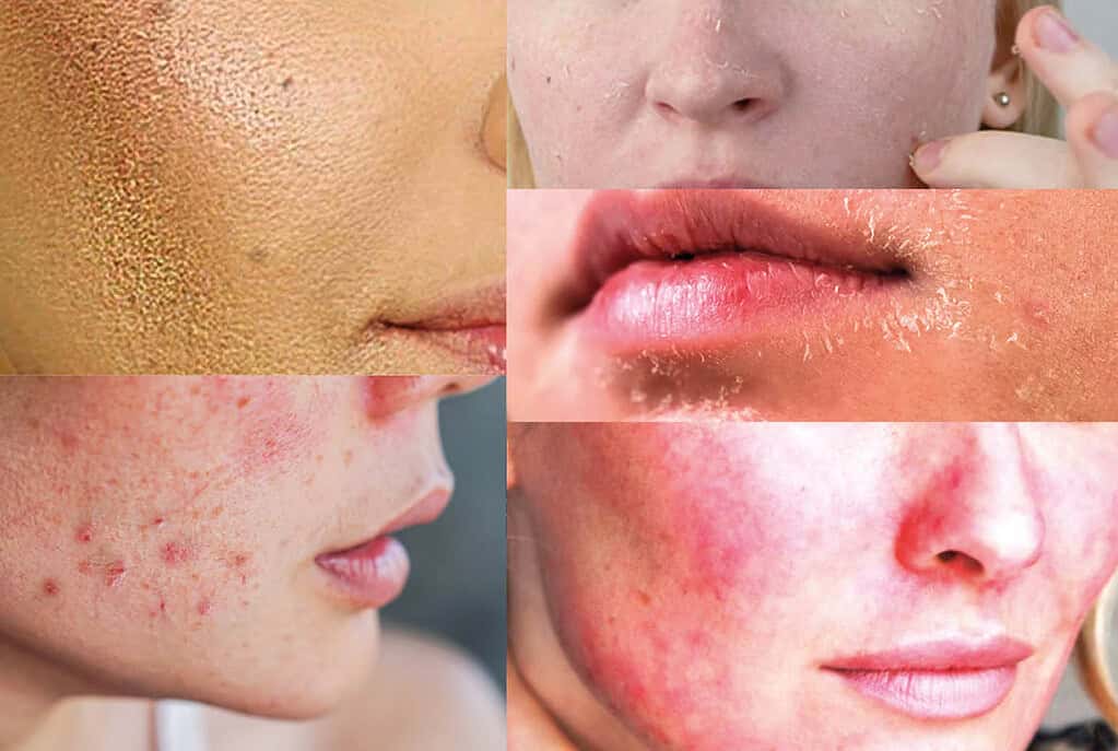 Winter skin problems